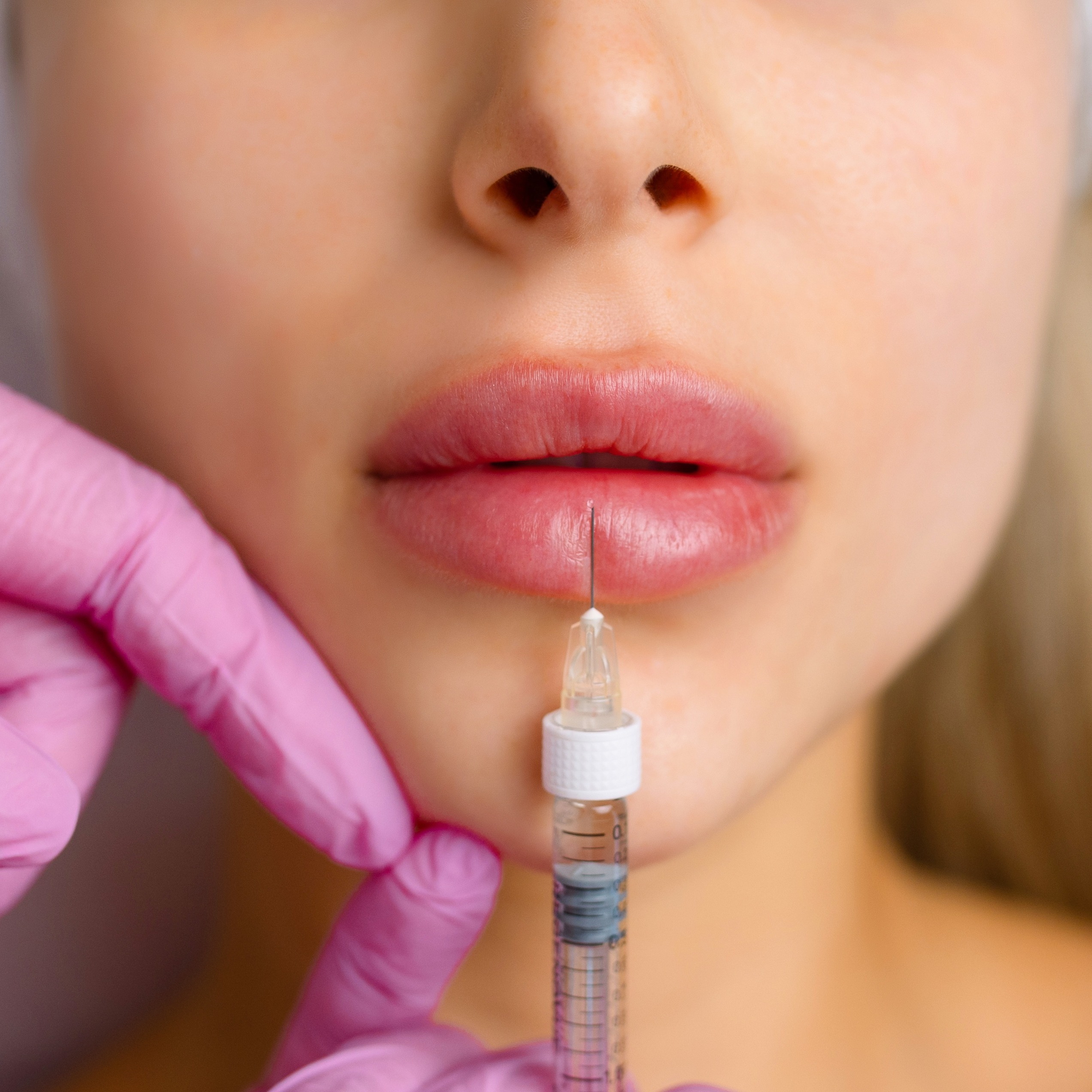 imgi_155_injection-procedure-for-lip-augmentation-close-up-2025-03-09-20-07-40-utc